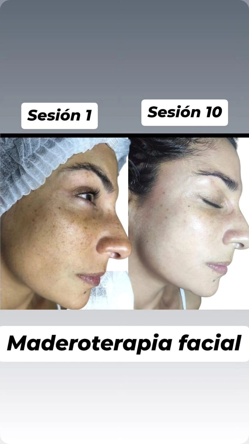 Maderoterapia Facial