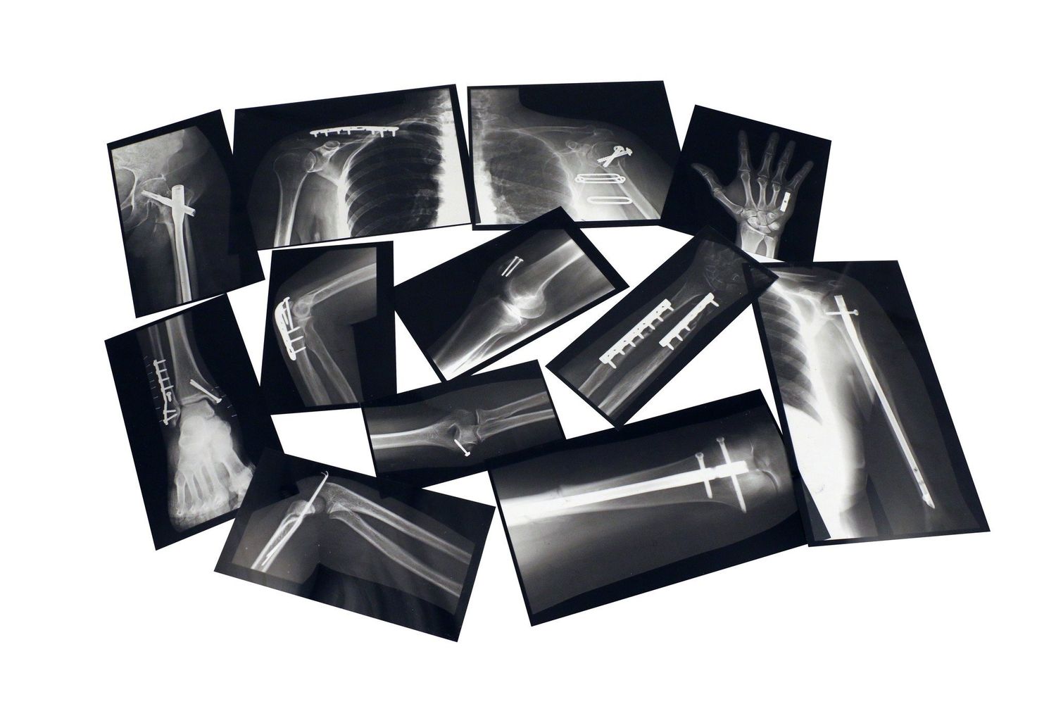 FIXED BONE X-RAYS