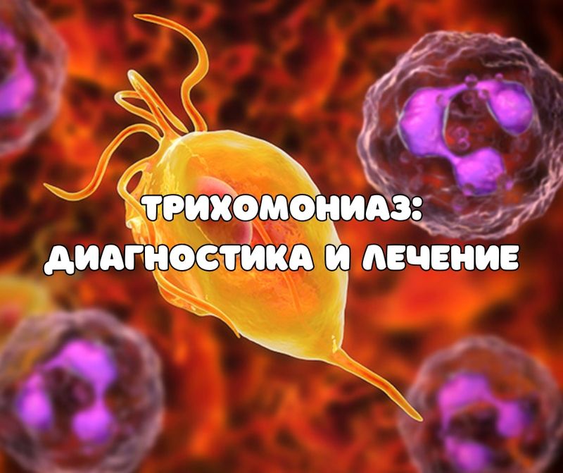 Трихомониаз: диагностика и лечение (АУДИО)