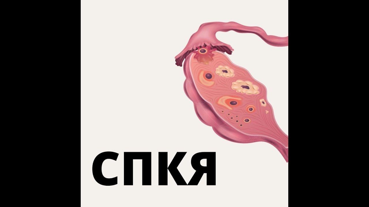 СПКЯ - приговор или коммерция (АУДИО)