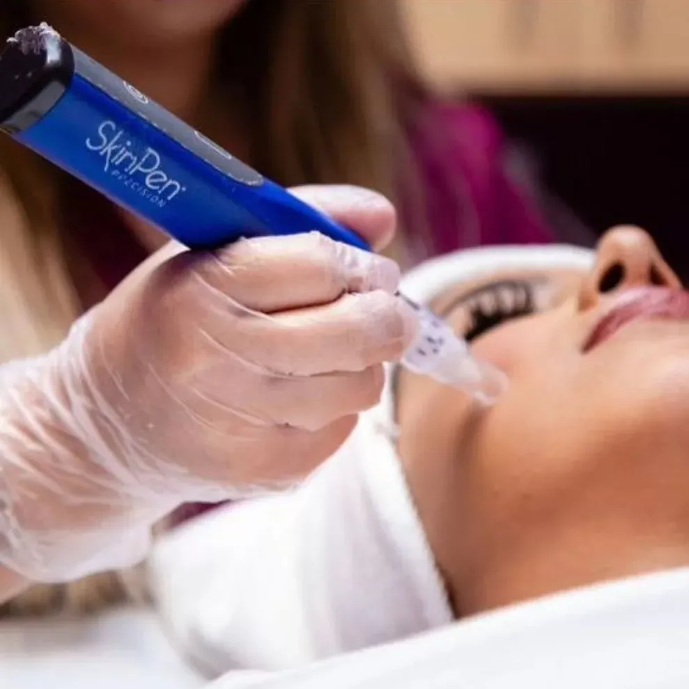 20% OFF Microneedling