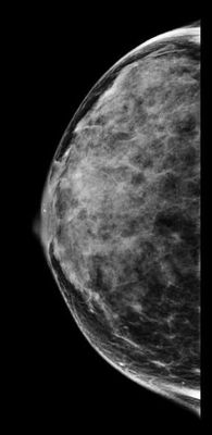 Mammography Examination Second Opinion