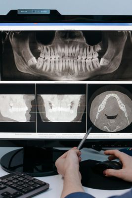 Guias Cirúrgicos e Biomodelos