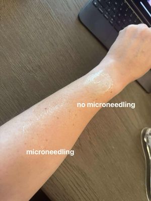 Microneedling Device + Retinol + TFEU Pearls