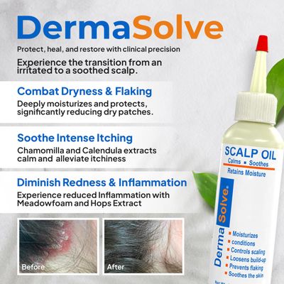 Dermasolve 4 oz Psoriasis, Seborrheic Dermatitis, &amp; Dandruff Scalp Oil | Dermatologist Approved | Itchy, Flaky Scalp Relief | Clinically Tested, Long-Lasting Itch-Free, High-Performance Formula