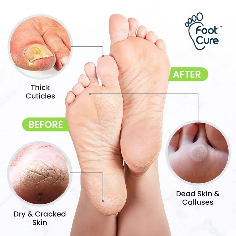 Foot Cure Foot Care Exfoliator &amp; Callus Remover Pedicure Set - Includes Foot File for Dead Skin, Tea Tree Oil Foot Soak Salts, Urea Cream 40 Percent &amp; Foot Callus Removal Gel - Made in USA