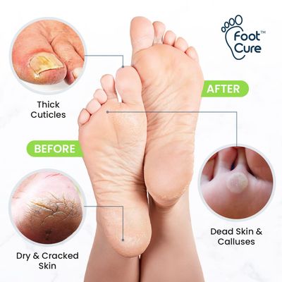 Foot Cure Foot Care Exfoliator & Callus Remover Pedicure Set - Includes Foot File for Dead Skin, Tea Tree Oil Foot Soak Salts, Urea Cream 40 Percent & Foot Callus Removal Gel - Made in USA
