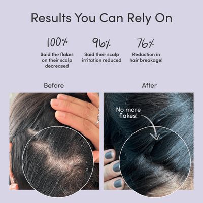 Jupiter Physician-Formulated Anti Dandruff Shampoo & Conditioner For Flaky, Itchy, Oily, Dry Scalp - Vegan, Sulfate Free - Color Safe & Paraben Free - Dry Scalp Shampoo and Conditioner For Women & Men