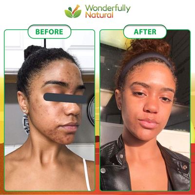 Organic African Black Soap - For Acne &amp; Dark Spots | Natural Vegan and Cruelty Free - Satisfaction Guarantee 1lb bar | 90 day Supply