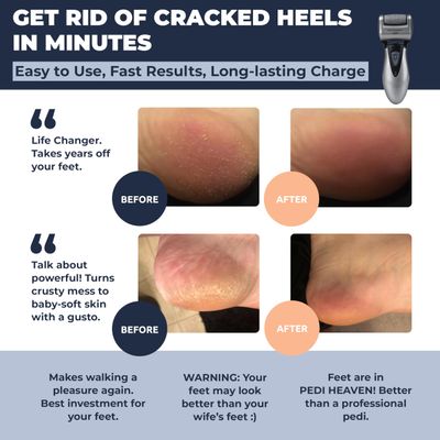 Electric Callus Remover Rechargeable Electronic Foot File CR900 by Own Harmony(Tested Most Powerful) Best Pedicure Tools w 3 Rollers Professional Pedi Feet Care Sander for Cracked Heels and Hard Skin