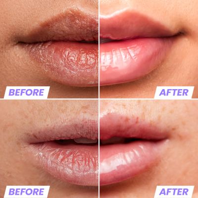 Wonderskin Lip Oil - Lip Rehab Serum Oil, Hydrating and Moisturizing Clear Lip Oil for Dry Lips - Natural, Vegan and Non-sticky Lip Gloss Oil
