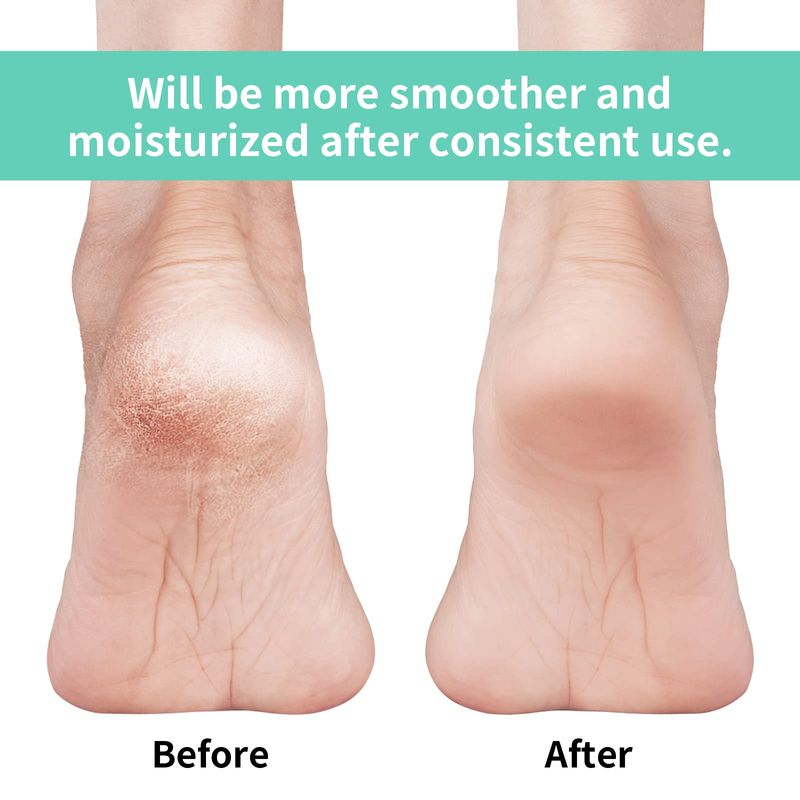 Vaincre Cracked Heel Repair Socks - 4 Pairs Moisturizing Heel Socks for Dry Cracked Feet, Gel Socks for Cracked Feet Heel Treatment, Spa Moisture Cracked Heel Socks for Dry Heels Overnight (Regular)