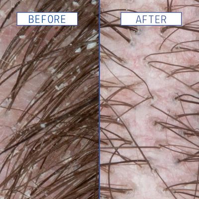 AAVRANI Scalp Rescue Serum - Salicylic Acid Treatment For Dandruff, Itchiness, &amp; Scalp Build Up - With Oatmeal &amp; Neem to Soothe - Vegan - 2 Fl Oz