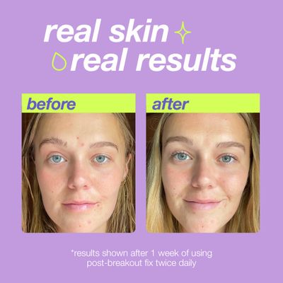 Dermalogica Clear Start Post-Breakout Fix, Acne Dark Spot Treatment with Salicylic Acid, Squalene &amp; Hexylresorcinol, Fade + Brighten Acne Marks