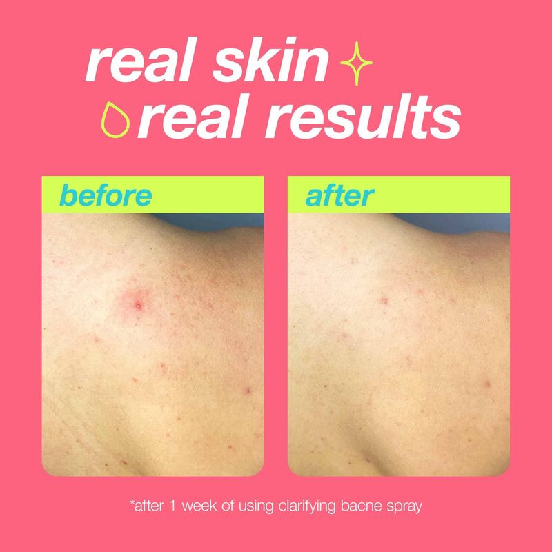 Dermalogica Clear Start Clarifying Bacne Spray - Back Acne Treatment Spray for Body Breakout, Pore Clearing, Preventing Pimple with Salicylic Acid, Witch Hazel, Tea Tree Oil, All Skin Type - 6 fl oz