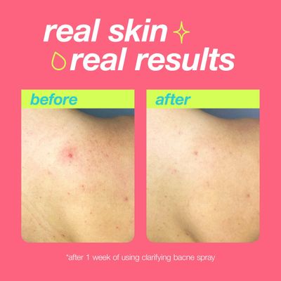 Dermalogica Clear Start Clarifying Bacne Spray - Back Acne Treatment Spray for Body Breakout, Pore Clearing, Preventing Pimple with Salicylic Acid, Witch Hazel, Tea Tree Oil, All Skin Type - 6 fl oz
