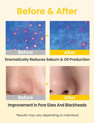 Elvira Pore Control Cleansing Oil, Makeup Remover for Sensitive, Oil Cleanser for Face, Blackhead Removal, Korean Skin care, Hydrating, Fragrance-Free