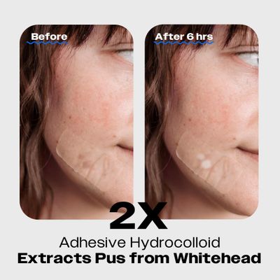 AVARELLE ZITOUT Large Hydrocolloid Pimple Strips (16 Patches) | Vegan Nose Patches for Pores Tea Tree | Chin Acne Patches for Face | Hydrocolloid Bandages for Acne | FSA &amp; HSA Acne Treatment