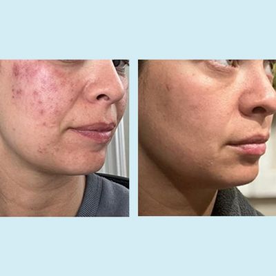 Glycolic Acid 50% Gel Peel - Enhanced with Retinol &amp; Green Tea Extract (Professional Skin Peel)1 ounce