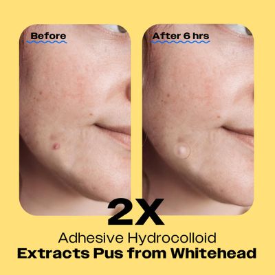 AVARELLE Invisible Acne Spot Patch (24 Count) Ultra Thin Hydrocolloid Spot Sticker for Day Time Acne l For Covering Zits & Blemish with Calendula, Rosehip Seed, Vegan, Cruelty Free