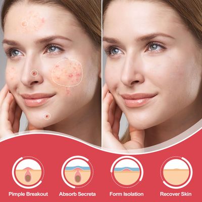 216 Counts Pimple Patches for Face, Hydrocolloid Acne Patches Zit Patches for Face Acne Spot Treatment Patch Cystic Acne Treatment Stickers Blemish Hydrocolloid Patches for all Skin Type