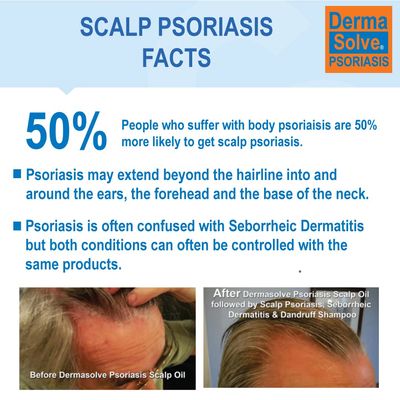 Dermasolve Scalp Psoriasis Medicated Shampoo &amp; Conditioner (2-pack) Naturally Heals Dandruff Seborrheic Dermatitis Itchy Flakey Inflamed Skin &amp; Provides Soothing Moisturizing Relief - Two 8 oz bottles