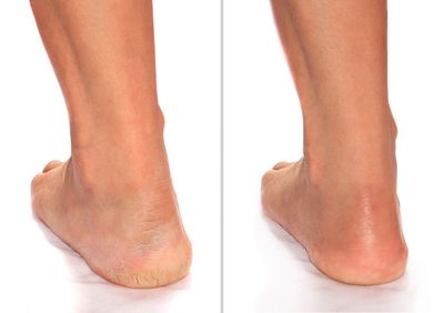 Advanced Clinicals Cracked Heel Foot Cream Skin Care Moisturizer Lotion For Feet W/Shea Butter | Helps Heal Cracked Skin, Rough Spots, Calluses, &amp; Dry Skin | Foot Lotion | Hand Lotion| Large 8 Fl Oz