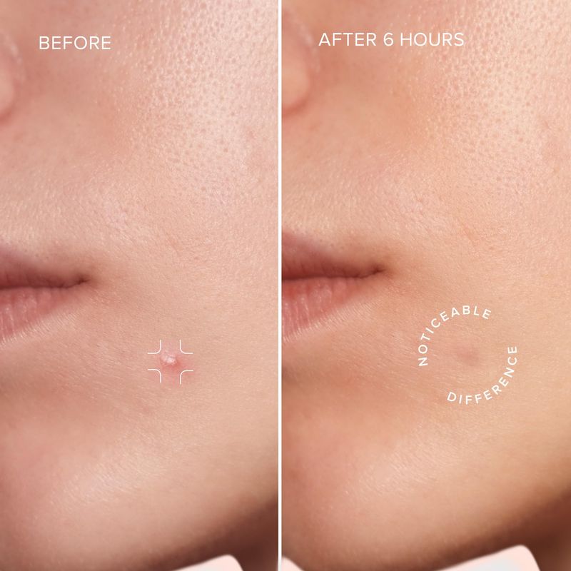 MAREE Star Pimple Patches for Face - Acne Patches - Natural Green Algae Extract &amp; Tea Tree Oil - Hydrocolloid Pimple Patches Cute Pimple Patches Stars for Cover Zit Patches, Parches Para Acne 72 Patch