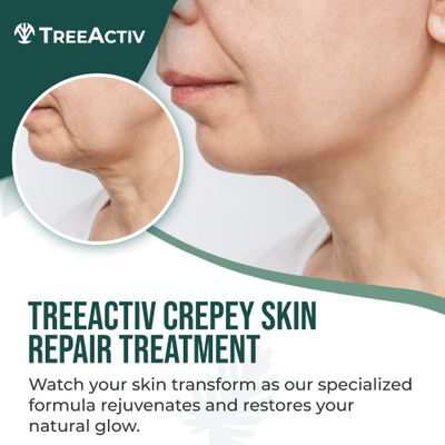 TreeActiv Crepey Skin Repair Treatment Original Formula, 8 fl oz, Firming Cream For Face & Neck, Skin Firming Lotion with Hyaluronic Acid, Crepey Skin Treatment to Address Dry Crepe Skin