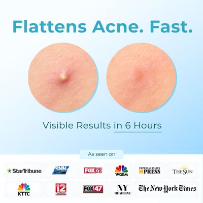 Hydrocolloid Pimple Patches (Made in Korea) FSA/HSA Eligible, Vegan, Hypoallergenic, Cruelty-Free | Acne Stickers, Overnight Treatment - for Zits, Spots, Pimples, Whiteheads (10 Count, XL Patches)