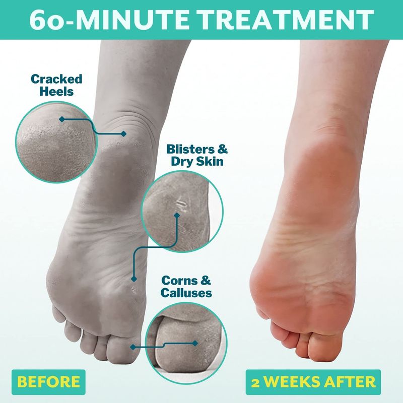 Patchology PoshPeel Pedi Cure - Foot Peel Mask Soak Treatment, Pedicure Foot Spa, Feet Peeling Mask, Pedicure Booties w/Deep Exfoliation for Baby-soft Skin, Pedicure Supplies for Foot Care, 1 Pair