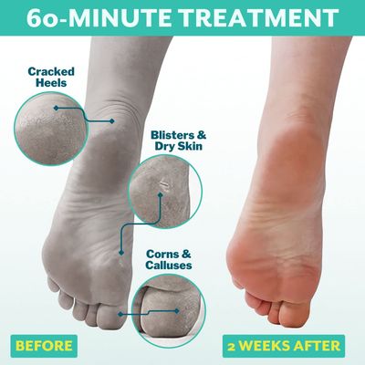 Patchology PoshPeel Pedi Cure - Foot Peel Mask Soak Treatment, Pedicure Foot Spa, Feet Peeling Mask, Pedicure Booties w/Deep Exfoliation for Baby-soft Skin, Pedicure Supplies for Foot Care, 1 Pair