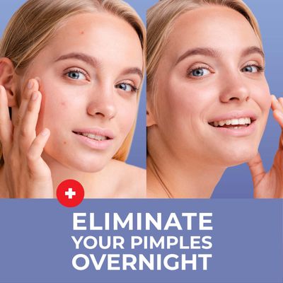 PatchRx Pimple Patches for Face (240 Patches), Hydrocolloid Acne Patches with Tea Tree Oil & Salicylic Acid, Pimple Patch Pimple Stickers, Hydrocolloid Patch Acne Dots Acne Pimple Patches For Face