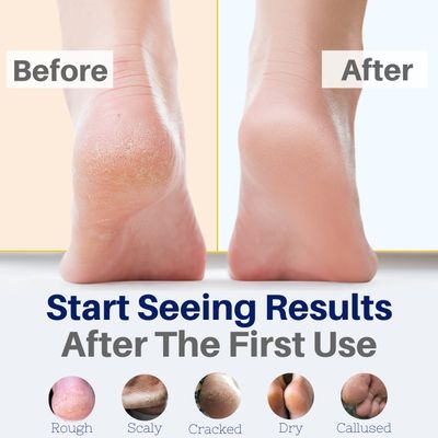 Yellow Bird Natural Foot Cream - For Dry and Cracked Feet Repair. Organic Athletes Foot Balm. Salve Moisturizer for Heel Care &amp; Callus Treatment with Tea Tree Oil &amp; Peppermint Essential Oils