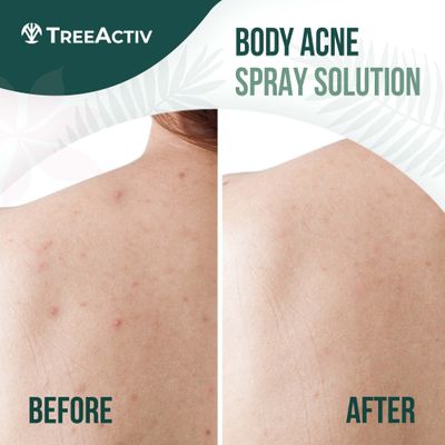 Salicylic Acid Back & Body Acne Spray, Back Acne Solution For Women And Men, Acne Body Spray with Tea Tree Oil, Fast-Drying Back Acne Spray, Fine Mist, Back Acne Treatment Spray, 4 fl oz, 2-pack