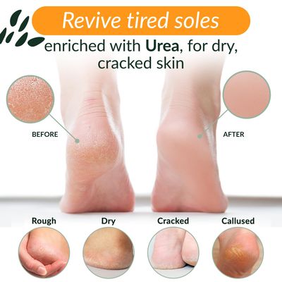 Tree to Tub Foot Cream for Dry Cracked Heels and Feet - Foot Lotion for Dry Cracked Feet, Non-Greasy Foot Moisturizer Urea Cream w/Softening Shea Cocoa Butter, Citrus Foot Care for Women &amp; Men