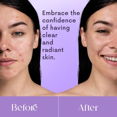 NXN Acne Edit Spot Treatment with Probiotics, Licorice Root, Ginger and Colloidal Sulfur, to rapidly reduce acne blemish size