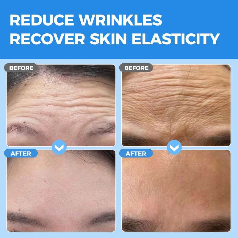 Okela Forehead Wrinkle Patches 20 pcs with Collagen, Vitamin, Anti Wrinkle Patches, Forehead Wrinkles Beauty Treatment