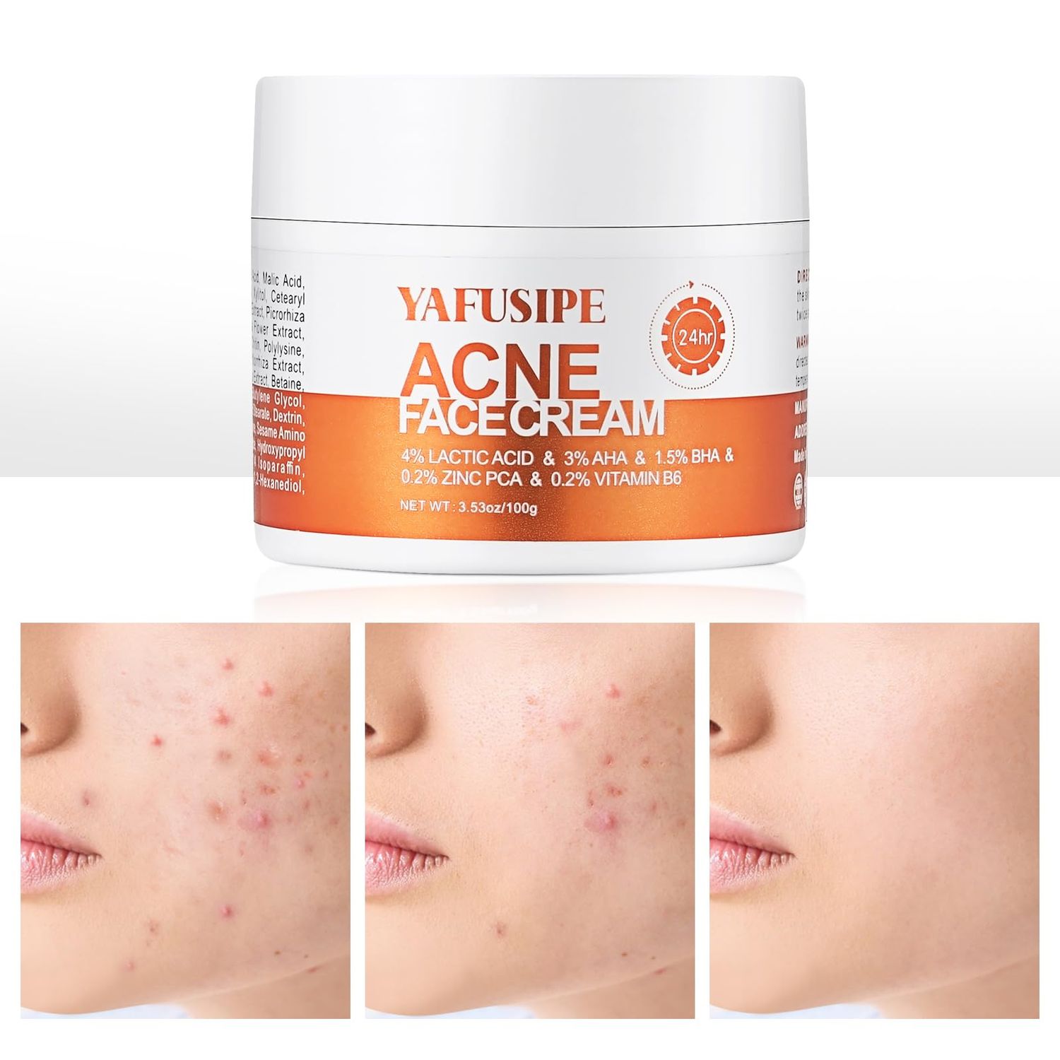 YAFUSIPE Acne Treatment for Face for Hormonal Cystic Stubborn Acne Cream for Sensitive Skin Teens Adults Women Men Spot Pimple Butt Control Rapid Clearing Breakout Overnight