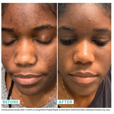 USRx Retinol Rapid Repair Treatment, Fast-Absorbing, Targets Fine Lines, Hyperpigmentation, and Blemishes, Fragrance-Free with Retinol, Squalane, Niacinamide and Kojic Acid, 1.0 Fl Oz