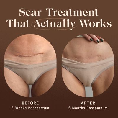Nemah - Restorative Scar Treatment - C Section Scar Treatment for Postpartum Scar - Dual-Action Maternity C Section Scar Cream &amp; Acne Scar Treatment - Vegan &amp; Cruelty-Free - 1 oz.