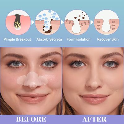 Vigorder Nose Pore Patches, Hydrocolloid Nose Patches, Medical-Grade Hydrocolloid Nose Strips, Targets Pimple, Pores &amp; Oil, Acne Patches to Absorb Acne Nose Gunk Overnight (10 Pack)