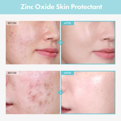 TOSOWOONG SOS Repair CICA Clinic Zinc Cream, 100,000ppm Zinc Oxide, Heal and Soothe Acne, Skin Barrier Repair, Moisture Barrier Cream, Non-Comedogenic, Korean Skincare, 50g, 1.76 oz.