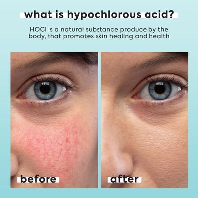 Hypochlorous Acid Spray for Face & Body - Helps Reduce Redness and Breakouts - Hypochlorous Spray - Multi-Purpose Topical Facial Skin Repair - pH-Balancing Toner - TSA Travel Size - Livaclean