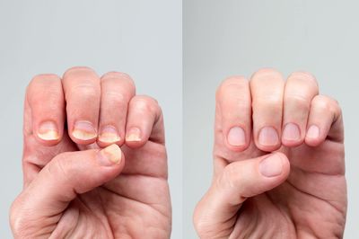 Miracle Fruit Oil Nail Strengthener Cuticle Oil - 10ml Nail Strengthener For Thin Nails And Growth - Intense Moisture and Protection - Optimal Nail Care Cuticle Softener for All Nail Types