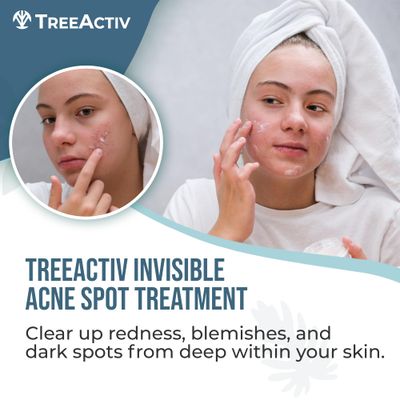 TreeActiv Invisible Acne Spot Treatment, 150+ Treatments, Salicylic Acid &amp; Tea Tree Oil No Show Spot Treatment for Cystic &amp; Hormonal Acne, Works for Blackheads &amp; Whiteheads