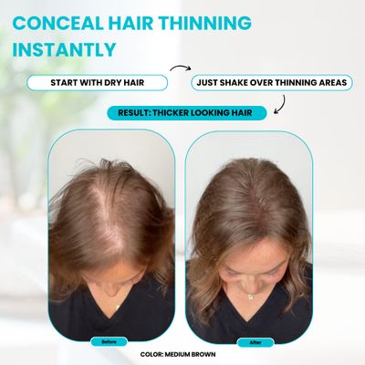 SURETHIK Hair Fibers, 30g (Dark Brown), Fills Thinning Hair for Visibly Fuller Look, Conceals Bald Spots, Natural Look, For Men &amp; Women
