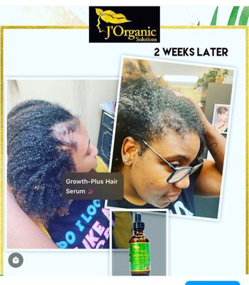 J'Organic Solutions Super Healthy Hair Growth Set (Complete 5 products Set)