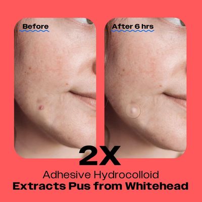 AVARELLE Pimple Patches for Face | ZITOUT Hydrocolloid Acne Patches for Covering Blemishes | FSA HSA Zit Patches with Tea Tree, Calendula, & Cica | HSA Store Eligible Items (12 mm, 80, Count)