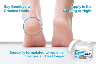 Clear Urea Cream 40% + 1% Hyaluronic Acid (4oz) | Softens Cracked Heels &amp; Dry Skin Urea Cream 40 Percent - Infused w Tea Tree &amp; Coconut Oil | Urea Cream for Callus &amp; Corn Treatment | Made in USA